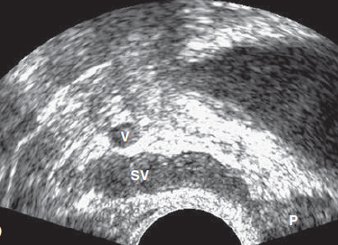 Normal seminal vesicles
